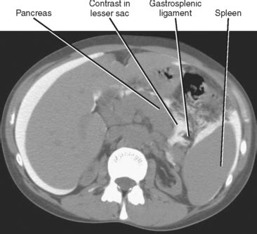 Gastrosplenic Ligament