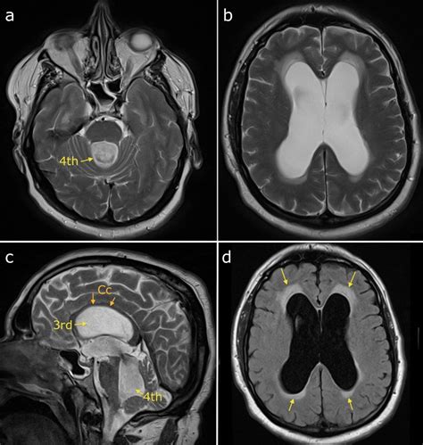 Obstructive hydrocephalus - Radiology at St. Vincent's University Hospital