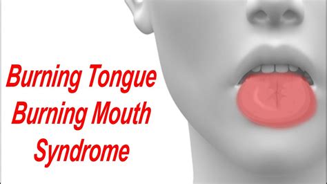 What Causes Burning Sensation On Tongue And Lips | Lipstutorial.org