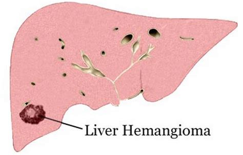 Some significant Symptoms of Liver Cancer - TWB