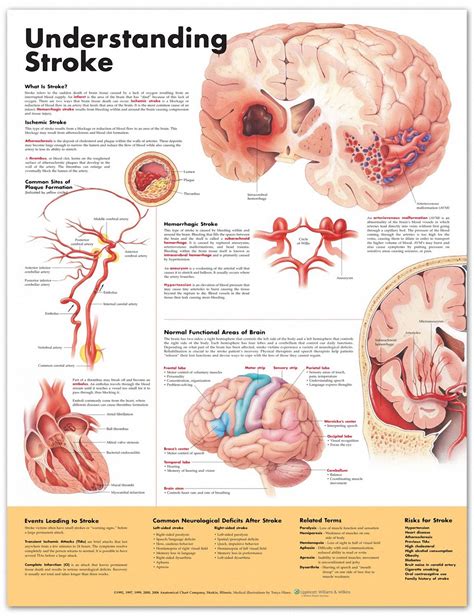 Understanding Stroke Chart | Medical technology, Neurology, Nurse