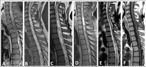 A, B In August 2018, cystic T2 hyperintense lesion predominantly in the... | Download Scientific ...