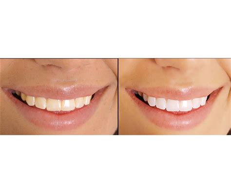 Teeth Whitening Kit online - 9 shades lighter teeth in 2 weeks! | Catch.com.au