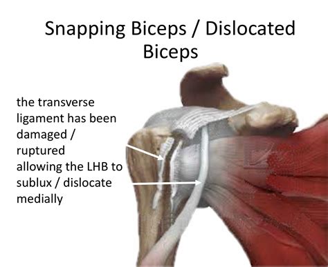 Long Head Biceps Tendon Subluxation