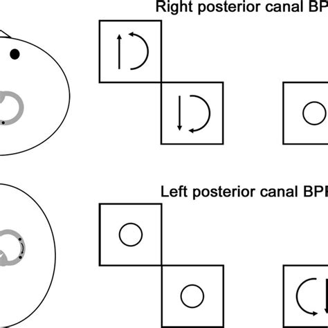 Gufoni maneuver (exemplified for a right-sided BPPV) (1) The patient is ...