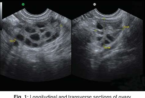 Figure 1 from Baseline Scan and Ultrasound Diagnosis of PCOS | Semantic Scholar