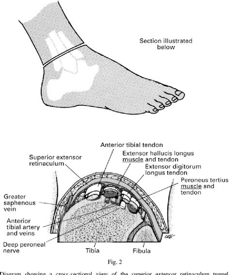 [PDF] Extensor retinaculum syndrome of the ankle after injury to the distal tibial physis ...