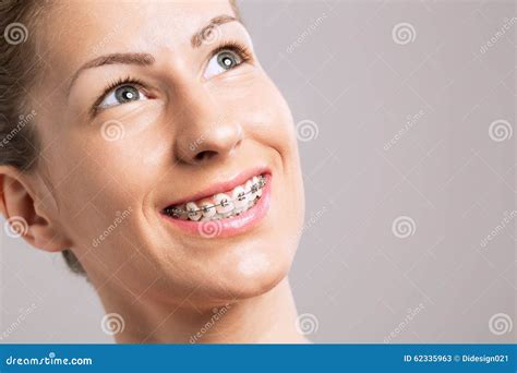 Braces Teeth Female Smile stock image. Image of lips - 62335963