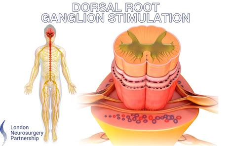 Dorsal root ganglion stimulation - London Neurosurgery Partnership