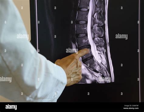 Doctor pointing at MRI of lumbar spondylosis on computer screen Stock ...