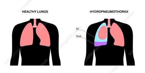 Hydropneumothorax, illustration - Stock Image - F041/5886 - Science Photo Library