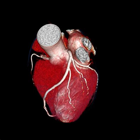 CT Angiogram & Calcium Score - Heart Specialist Clinic Singapore