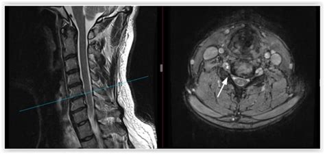 Cervical Foraminotomy | OrthoManhattan