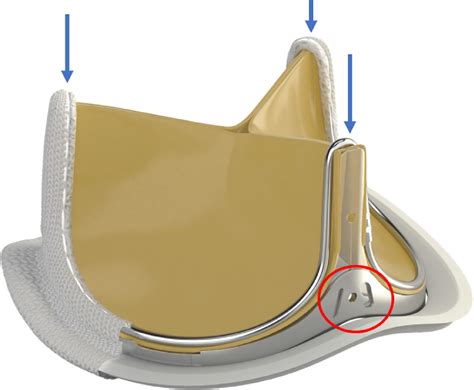 Supplemental Materials for Perioperative and Echocardiographic Considerations for the Inspiris ...