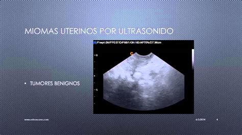 MIOMAS UTERINOS VISUALIZADOS POR ULTRASONIDO - YouTube