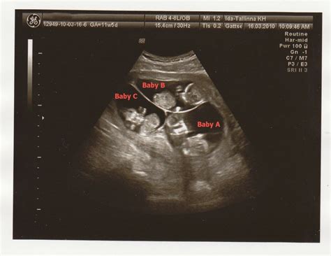 Triplets - This is the only picture where they were seen alltogether - in week 12. Later, they ...