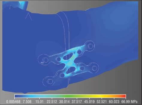 Measurement of von Mises stress (in megapascals) in the InterFlex plate... | Download Scientific ...