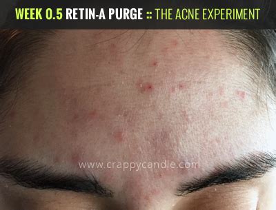 How to Use Retin-A & Survive the Purge :: The Acne Experiment | Crappy ...