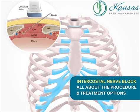 Intercostal Nerve Block Procedure Treatment Options – NBKomputer