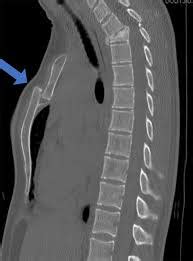 Sternal fracture