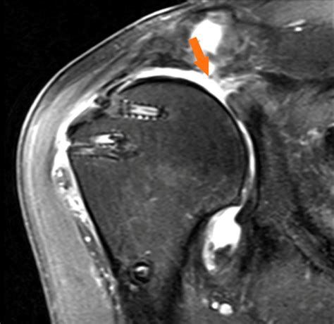 Rotator Cuff Tear MRI Right Shoulder