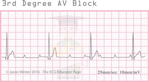 3rd Degree Heart Block - Photos Idea