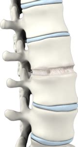 Anterior Cervical Corpectomy and Fusion Houston | Bellaire, Texas