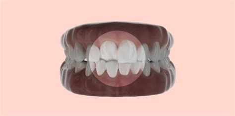 Crossbite: treatment & causes | bestsmile