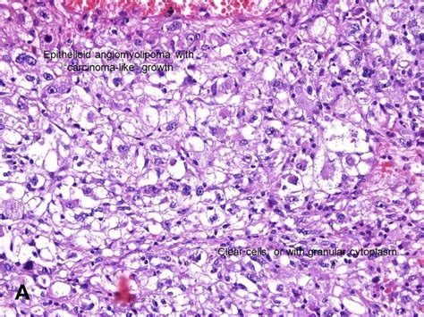 American Urological Association - Epithelioid Angiomyolipoma