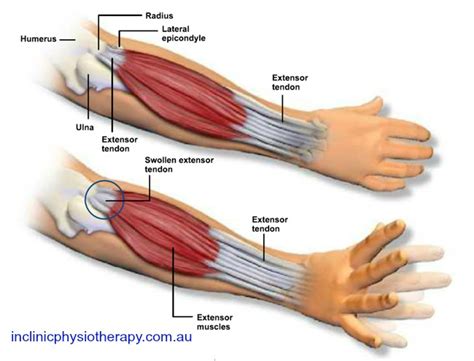 Tennis Elbow? But I Don't Even Play! - In Clinic Physiotherapy