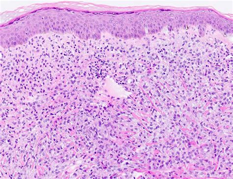 Pathology Outlines - Juvenile xanthogranuloma