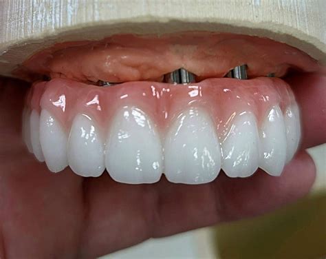 A Maxillary PMMA (Polymethyl Methacrylate) hybrid prototype with gingival layered composite ...