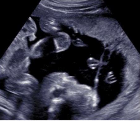 Amniotic band syndrome: A case series - Journal of Case Reports and Images in Obstetrics and ...