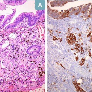 Histological aspects of polypoid lesions. Tubulo-villous adenoma with ...