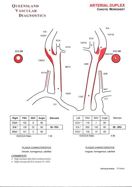 Carotid Duplex Scanning - Queensland Vascular Diognostics