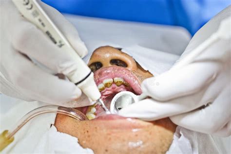 Dental Prophylaxis stock photo. Image of orthodontist - 33145990