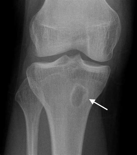 Osteomyelitis 04: Take a picture… It’ll last longer – PEMBlog