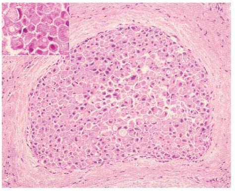 Lobular Carcinoma In Situ: Biology and Management | Oncohema Key