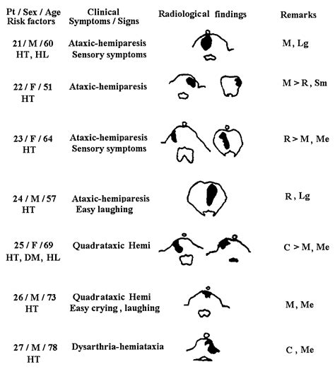 Paramedian Pontine Infarct