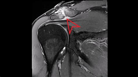 Acromioclavicular Joint Mri | The Best Porn Website