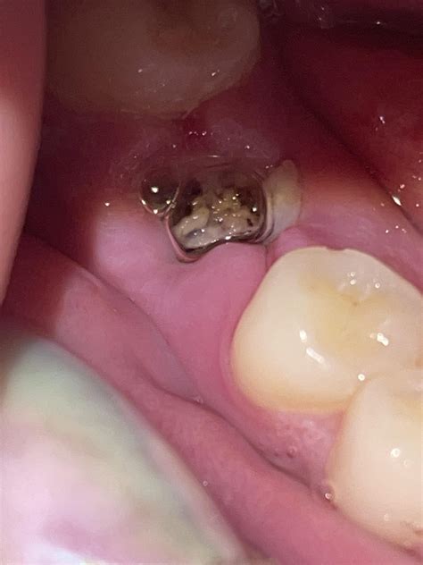 Infection? Dry Socket? Normal Healing? : r/DentalDudes