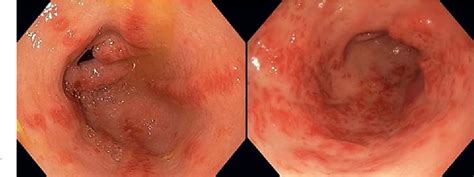 Figure 1 from Endoscopic Treatment for Gastric Antral Vascular Ectasia: Current Options ...