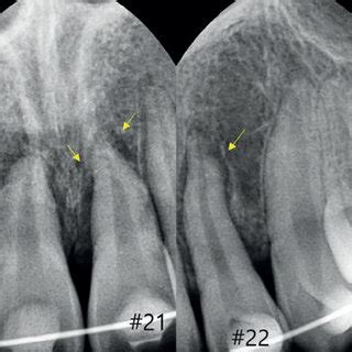 (a) Splinting of the avulsed teeth after replantation. The space around... | Download Scientific ...