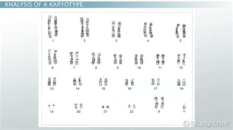 Human Karyotype Overview, Disorders & Examples - Video & Lesson Transcript | Study.com