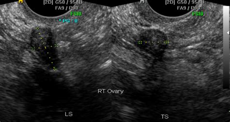 Ovarian Cancer Normal Pelvic Ultrasound Images - Follicle Detection And ...