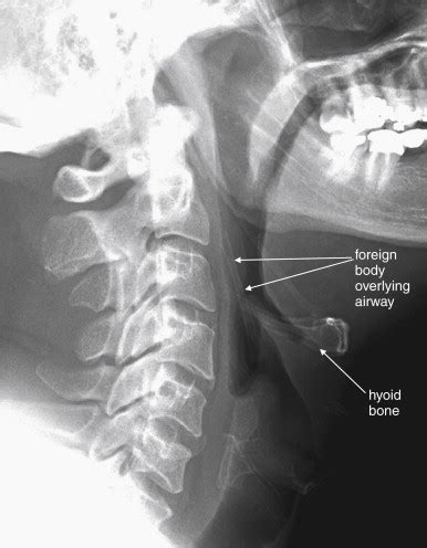 Imaging Soft Tissues of the Neck | Radiology Key