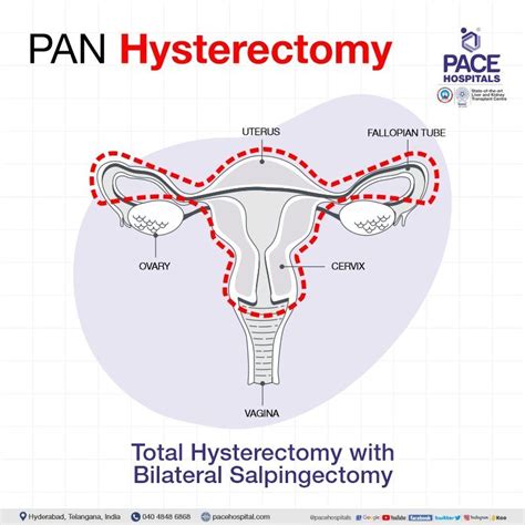 Hysterectomy Surgery in Hyderabad - Indications, Side effects & Cost