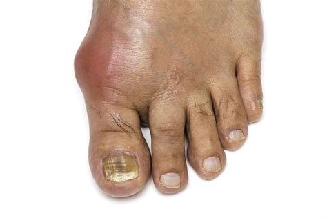 Gout: Signs, Symptoms, and Complications