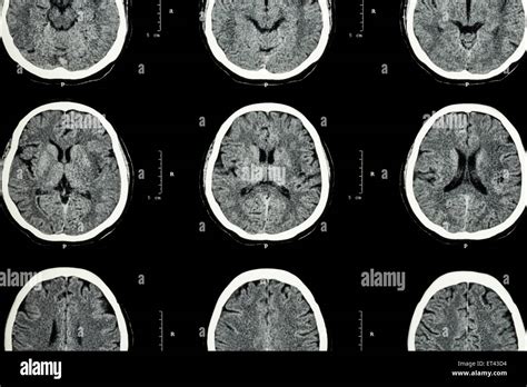 CT scan of brain show normal brain ( Neurological background Stock Photo - Alamy
