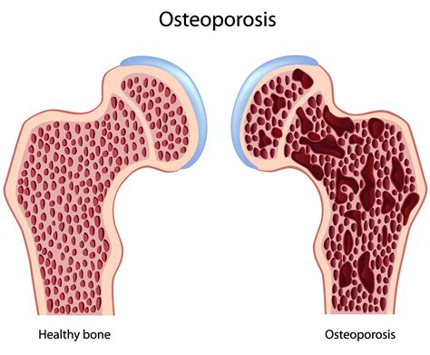 Osteoporose - Dr.med. (RO) Catalin Teodosiu, Frauenarzt, Horgen - Gynäkologie Lakeside Zurich